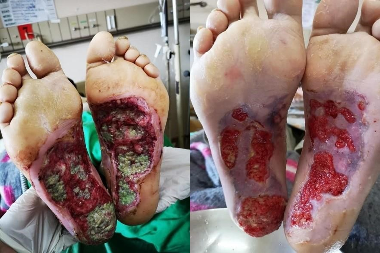 Gangrene — before CD